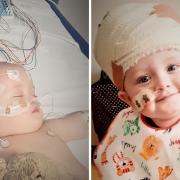 Oscar, who underwent 1 1 surgeries for his brain tumour